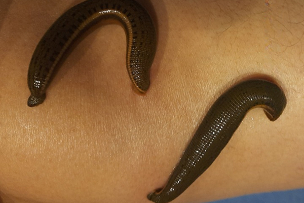 leech therapy 1