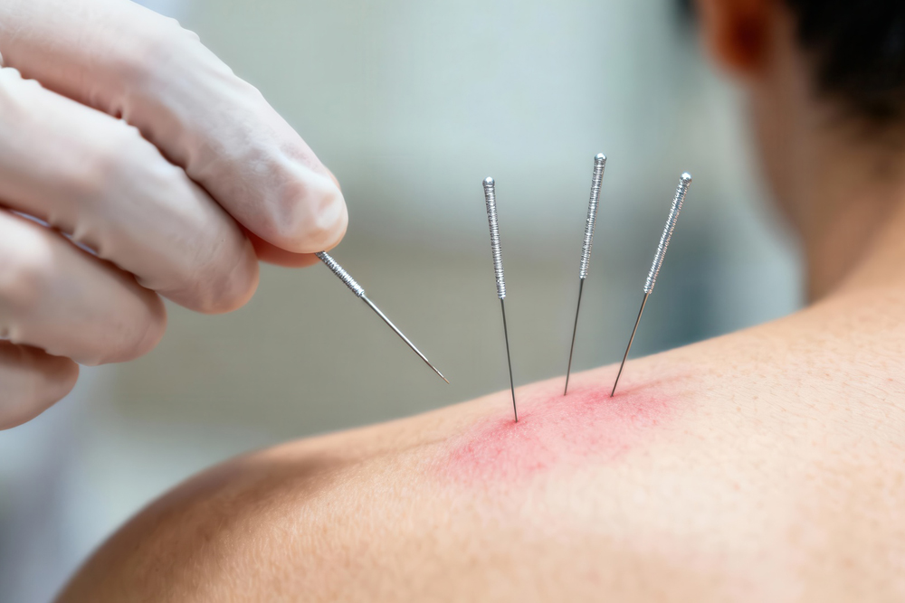 acupuncture needle